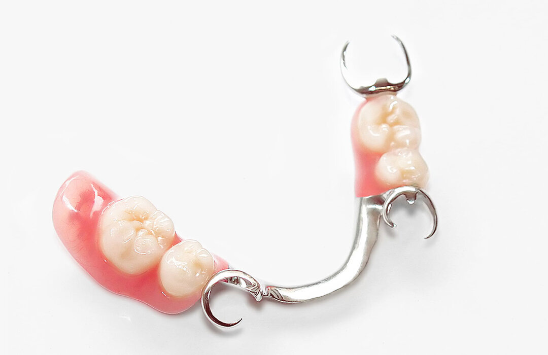 Вот так выглядит классический бюгельный протез. Но под него нужно,чтобы на челюсти было достаточно своих надежных зубов(минимум 6)