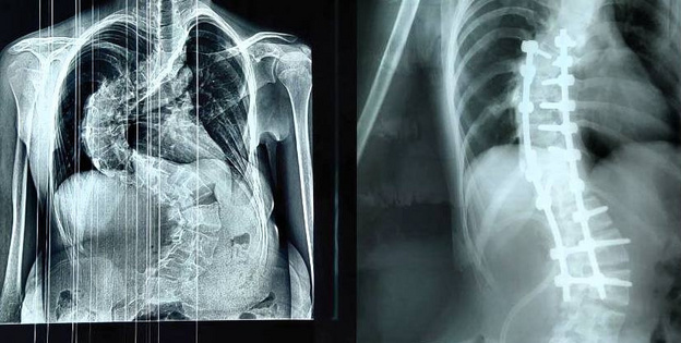    В Кирове провели сложную операцию по исправлению сколиоза у 14-летней девочки