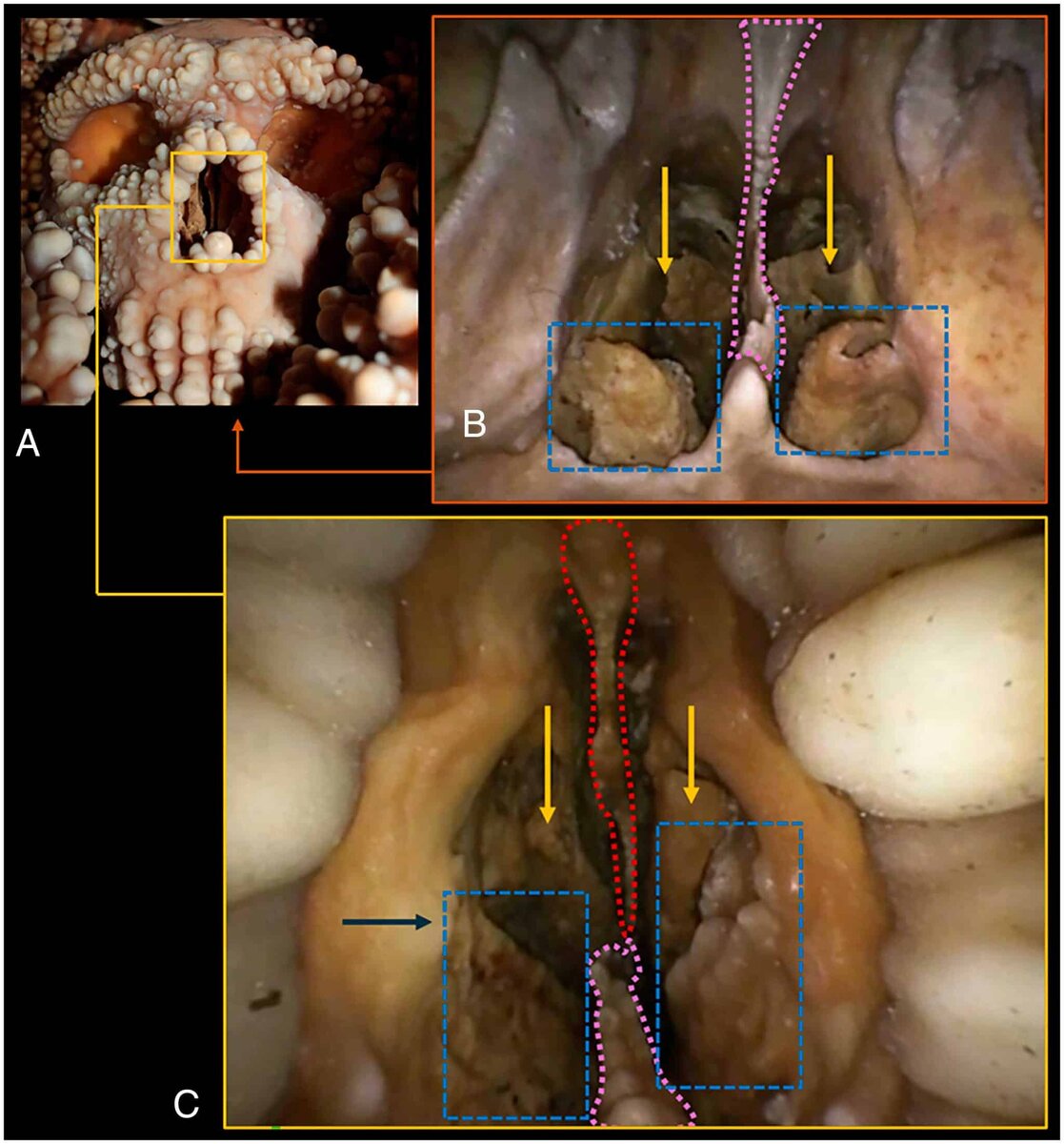    Анатомические структуры носовой полости черепа «Человека из Альтамуры». A: Изображение самого черепа. Для наглядности он перевернут по сравнению с тем, как его нашли. B и C: снимки, сделанные с помощью эндоскопа. Они показывают заднее (B) и переднее (C) отверстия носовой полости / © Costantino Buzi