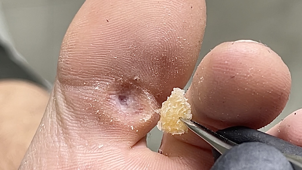 Мозоль в нехарактерном месте образования