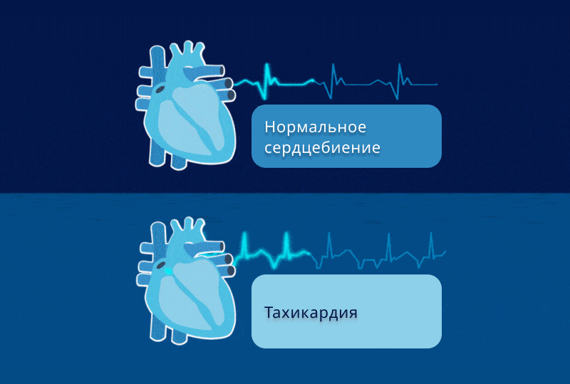 Тревожное сердце: Когда срочно бежать к врачу при ? Объясняет кардиолог
