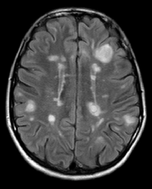 Очаги рассеянного склероза в головном мозге на снимке МРТ