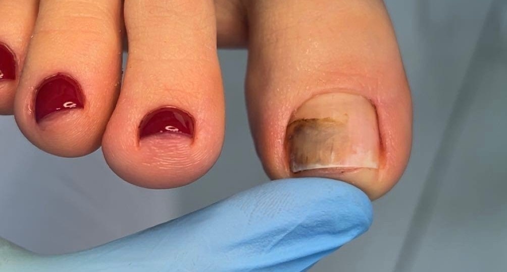 Синегнойная палочка на ногтях: признаки, причины возникновения и лечение