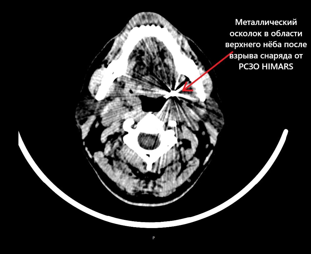 КТ головы пациента с осколком в области верхнего нёба.