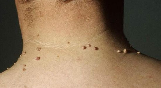 Папилломы на коже, возраст и инсулинорезистентность: какая между ними связь?