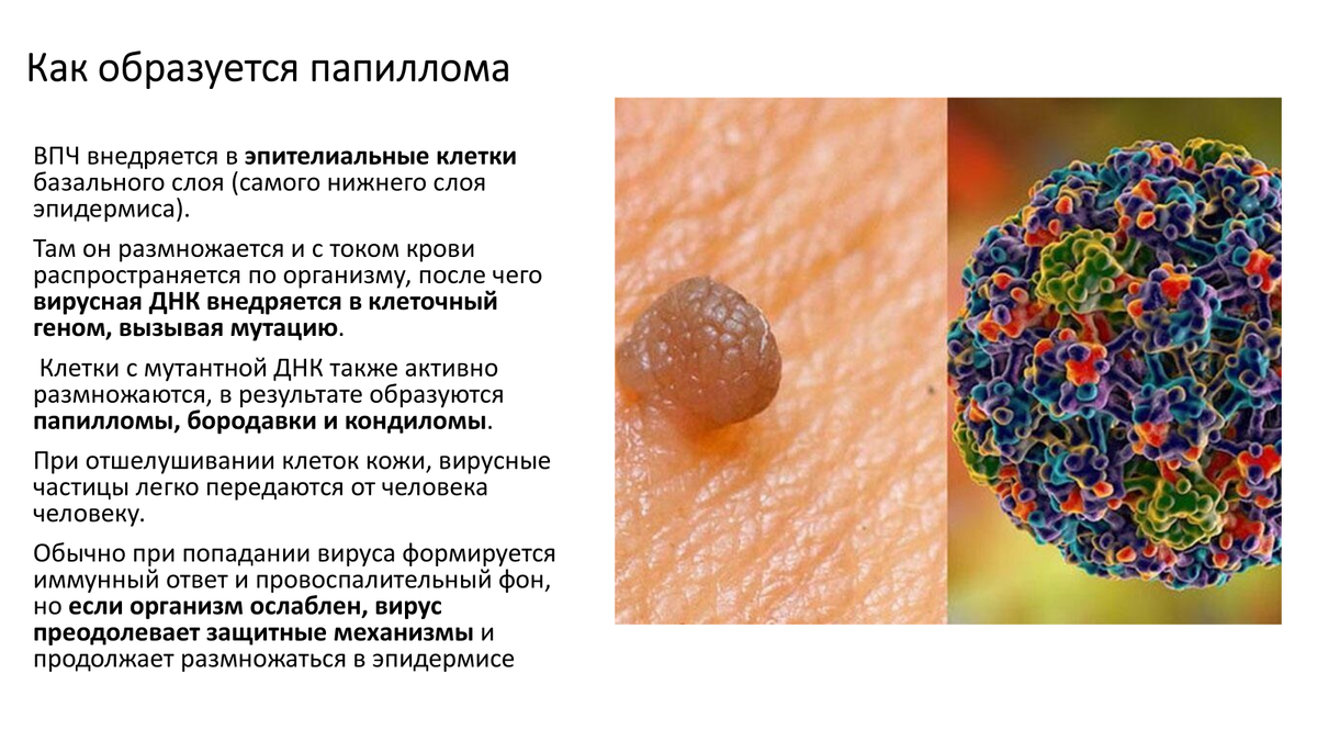 Справа - папиллома и электронное изображение вируса ВПЧ