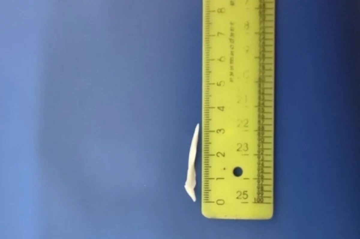    Саратовские врачи спасли мужчину с застрявшей рыбной костью