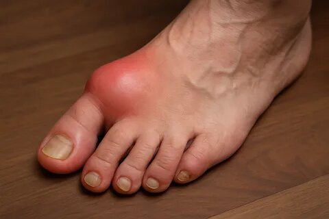 Как избавиться от мочевой кислоты — простой путь к лёгкости в суставах и хорошему самочувствию