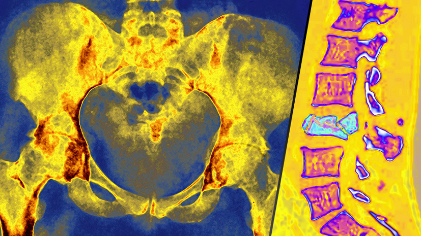     Поражение костей при остеопорозе / Gettyimages.ru / BSIP / UIG / CAVALLINI JAMES / Universal Images Group