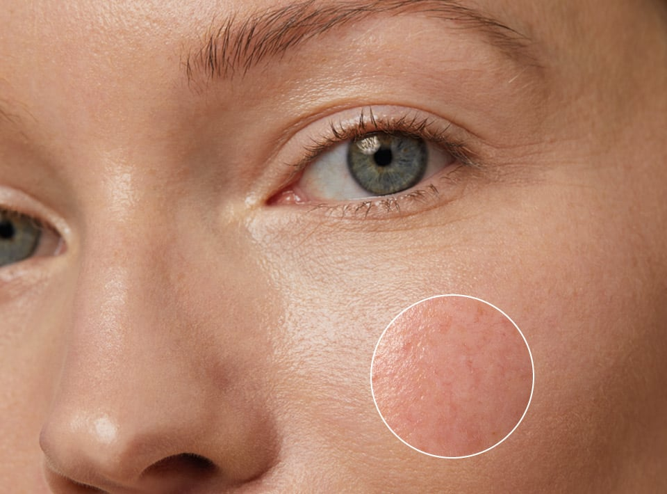 Уход при куперозе