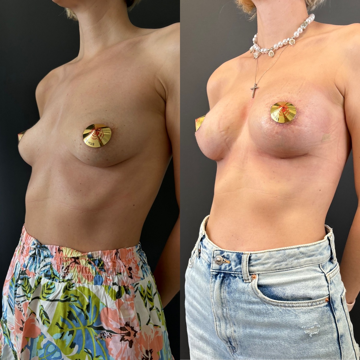 Маммопластика: результат через 1 месяц после операции. Хирург к.м.н. Остринская Т.В.