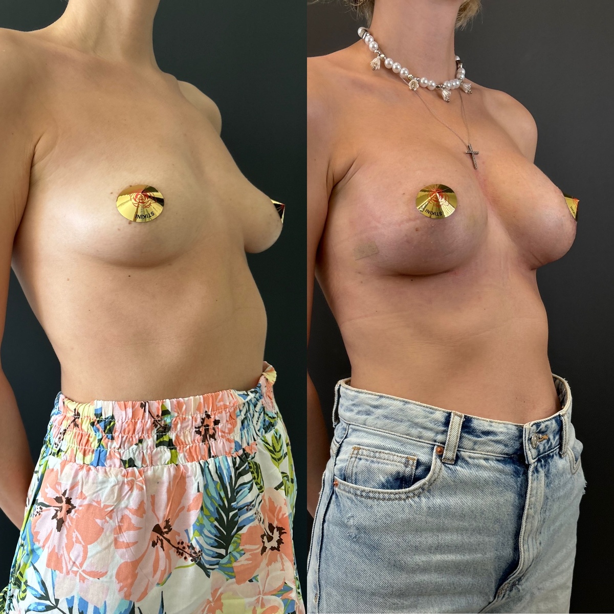 Маммопластика: результат через 1 месяц после операции. Хирург к.м.н. Остринская Т.В.