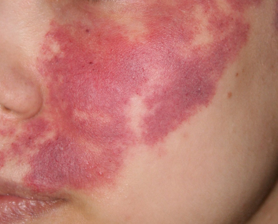 "Винное пятно" пациентка 35 лет