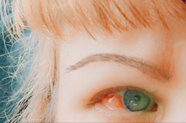 Так выглядел мой пострадавший глаз... 15 ноября