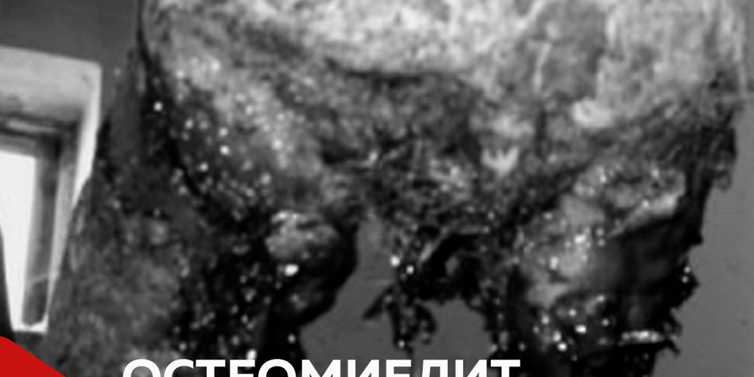 🐄 Остеомиелит фаланги у коров - болезнь, которая крадёт здоровье и продуктивность!