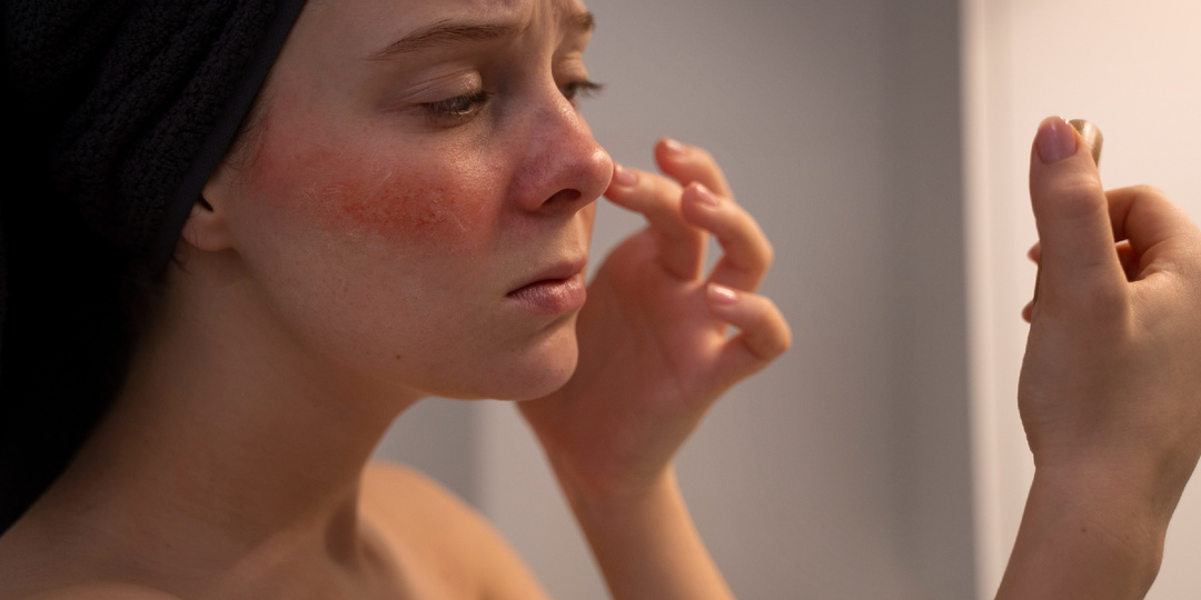 Розацеа на лице: что это и как лечить