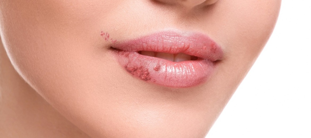 Герпес: Невидимый пассажир на всю жизнь — как не дать ему власть над вами
