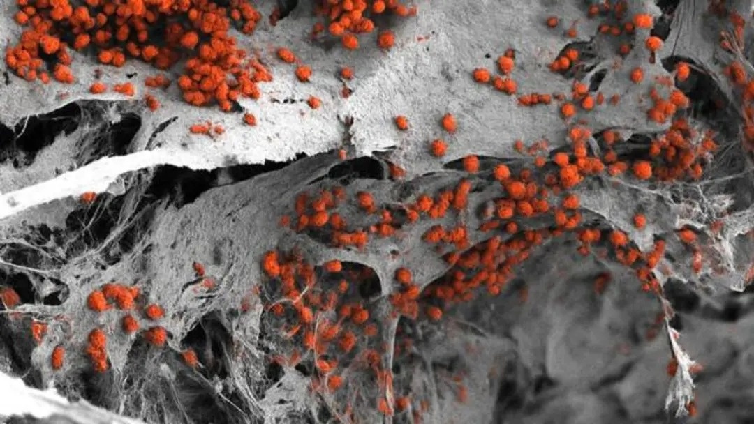 Изображение, полученное с помощью сканирующего электронного микроскопа, трёхмерной модели ткани костного мозга, колонизированной клетками крови человека (красный).    
 Источник: Andres Garcia Garcia, University of Basel, Department of Biomedicine  📷
