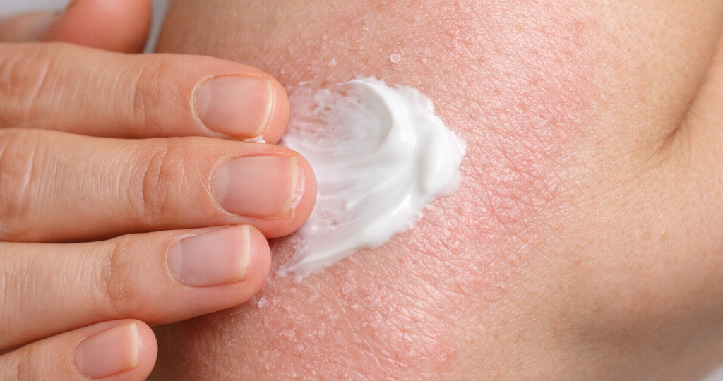 Сухая, зудящая, воспалённая кожа? Всё про экзему и её лечение