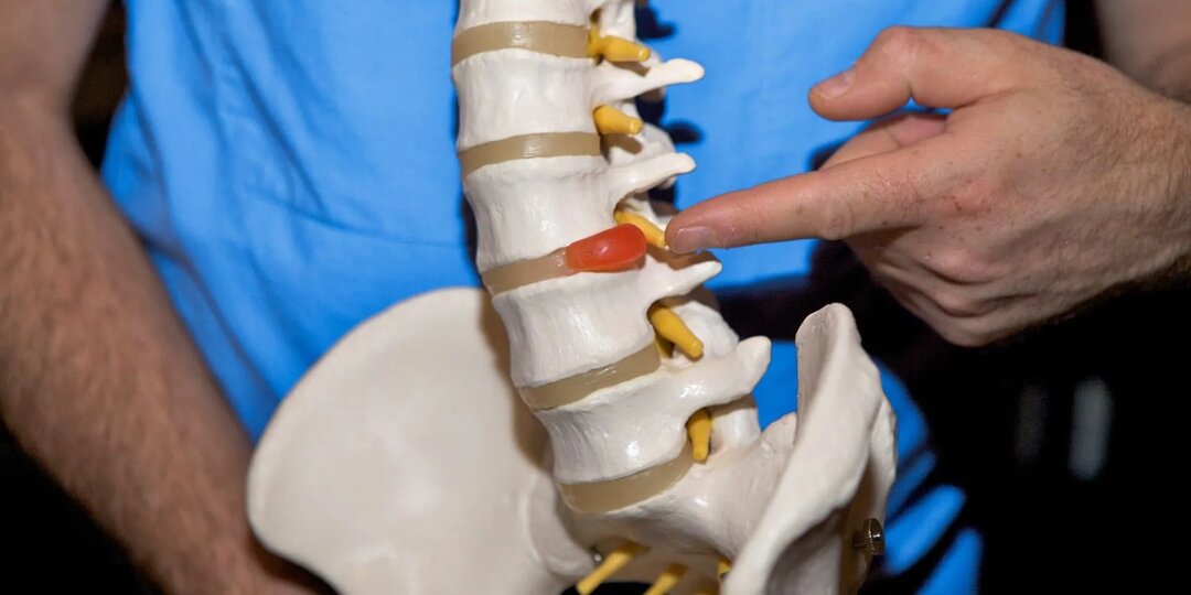 Поясничная грыжа: что это, почему возникает и как с этим жить