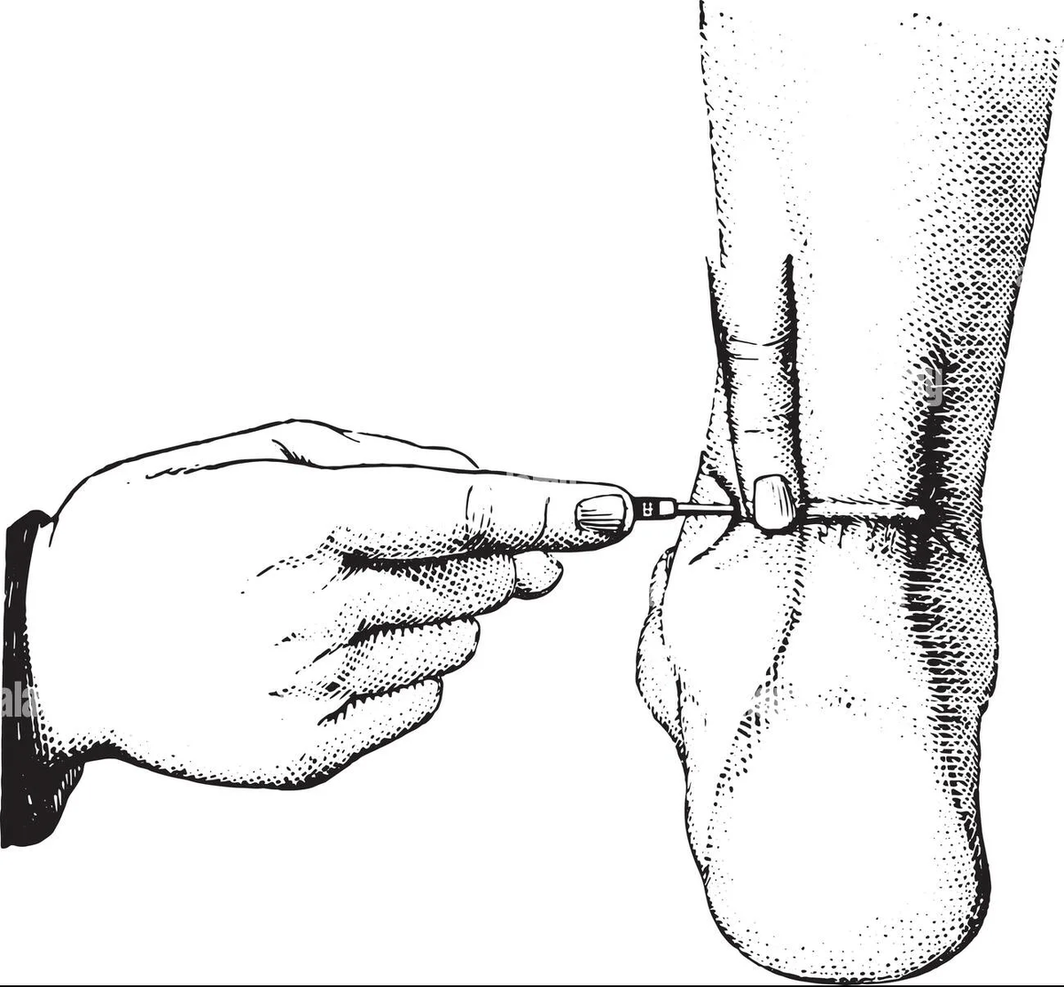 Тенотомия - хирургическая процедура, заключающаяся в частичном или полном разрезании сухожилия