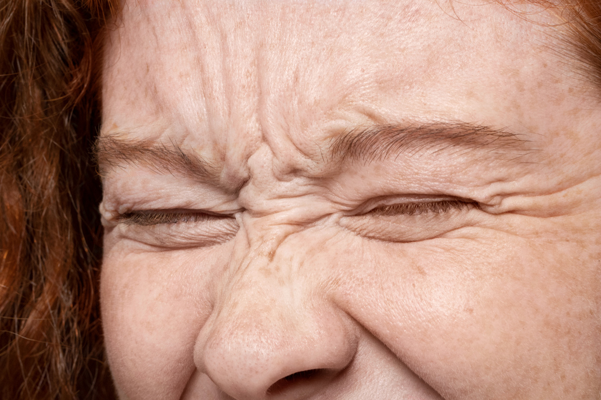 Активная мимика ведёт к образованию морщин и «гусиных лапок»  