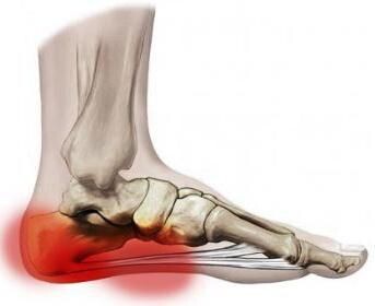 Пяточная шпора: почему пятка кричит от боли — и как вернуть себе лёгкую походку