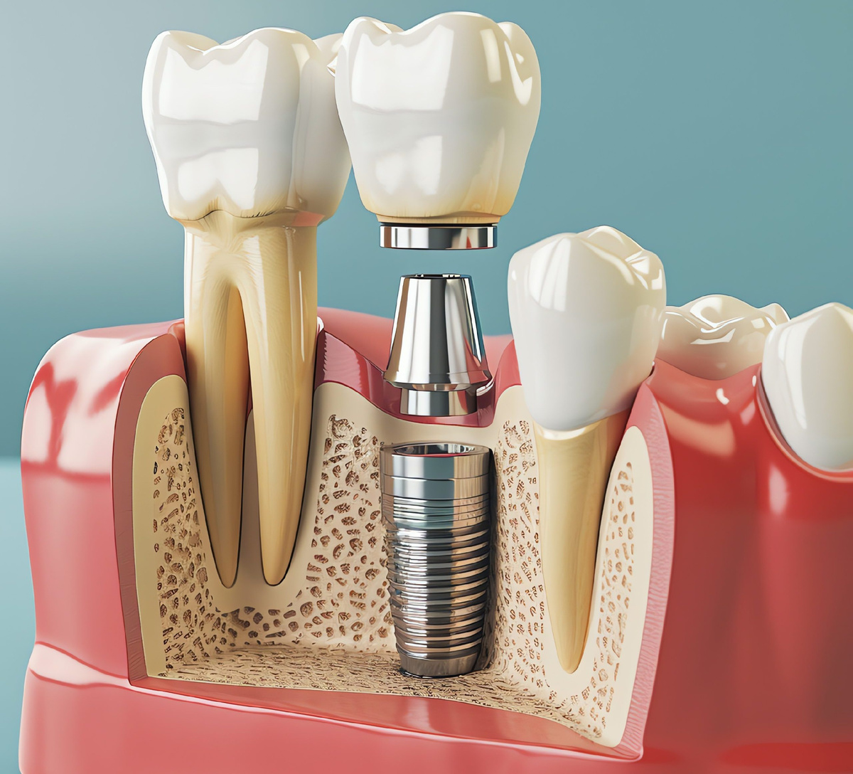 Состояние костной ткани