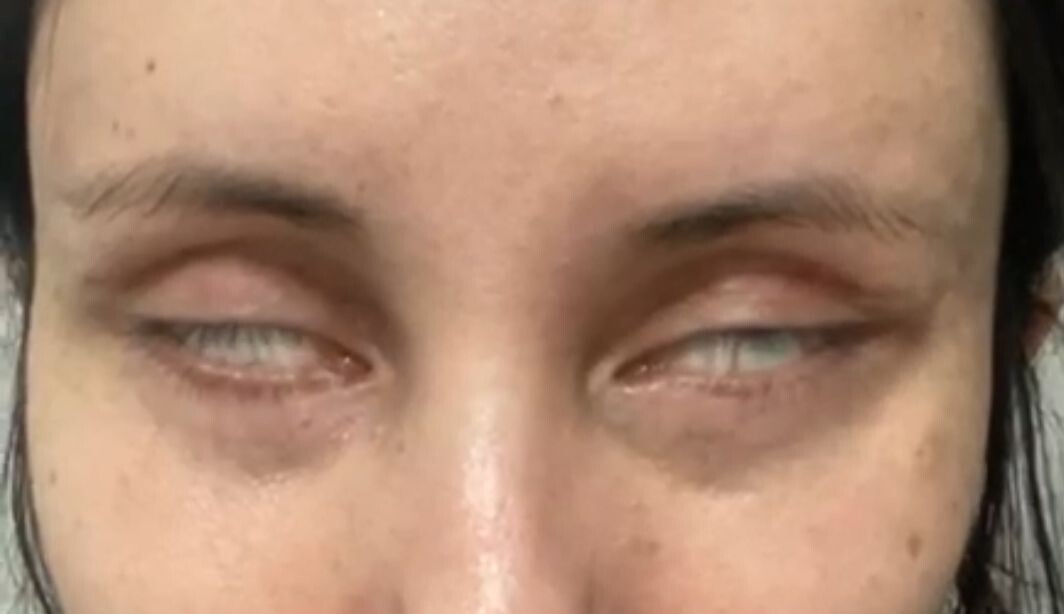 Пациентка пытается закрыть глаза. Веки катастрофически не смыкаются.