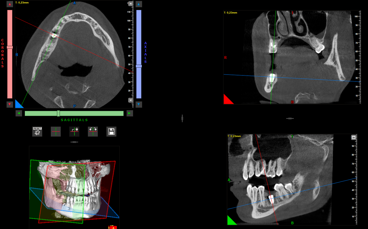 Контрольный снимок перед вторым этапом 