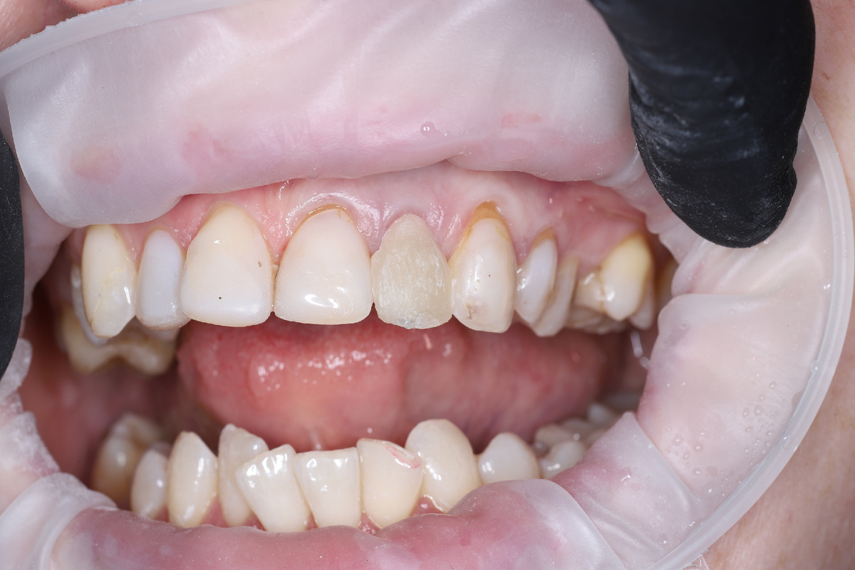 восстановление на анкерном штифте 