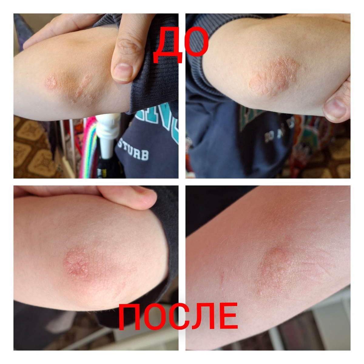 Работа активатором клеток около 5 раз по несколько минут, месяц спустя.