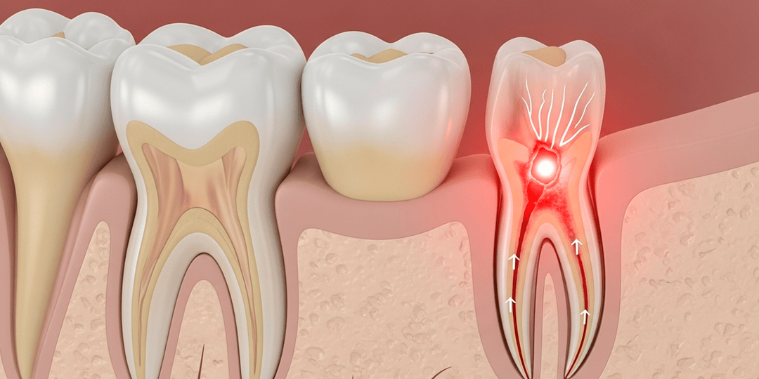 Болит мертвый зуб под коронкой: причины боли депульпированного зуба и методы лечения