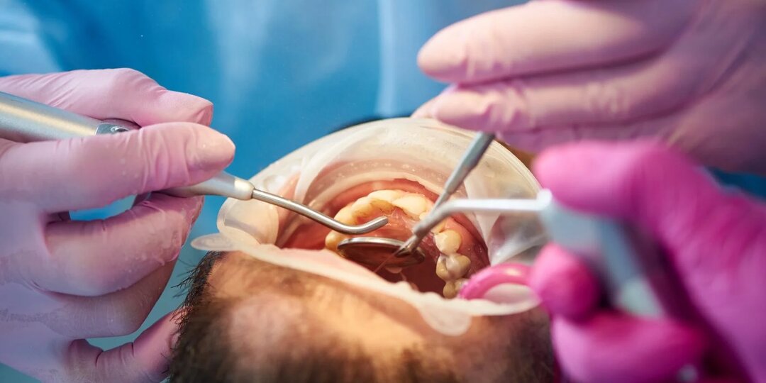 Сколько стоит имплант зуба и из чего складывается цена