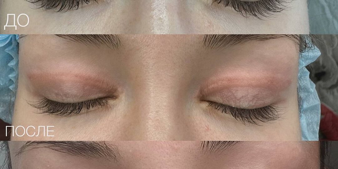 Рубцы после пластики: Как помочь коже восстановиться бесследно?