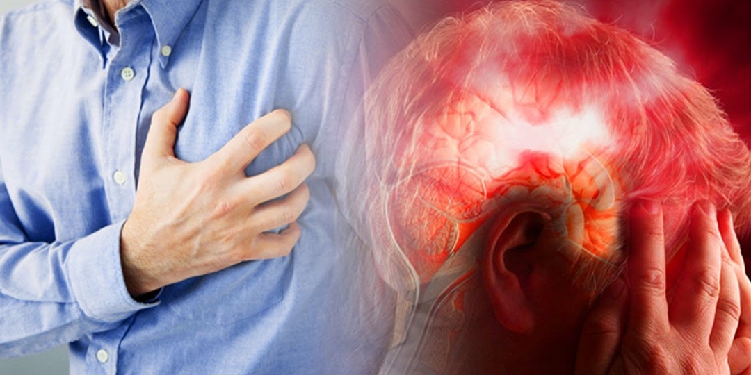 Когда Головокружение Может Быть Сигналом Сосудистой Катастрофы