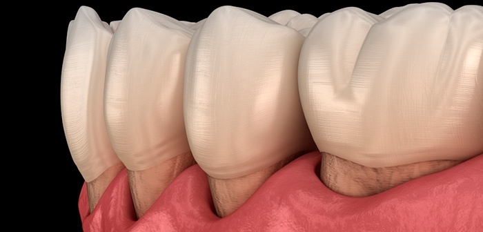 Клиновидный дефект