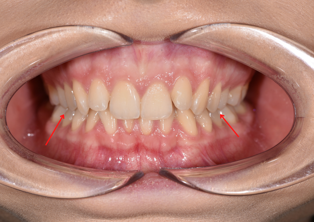 наклон внутрь на нижней челюсти