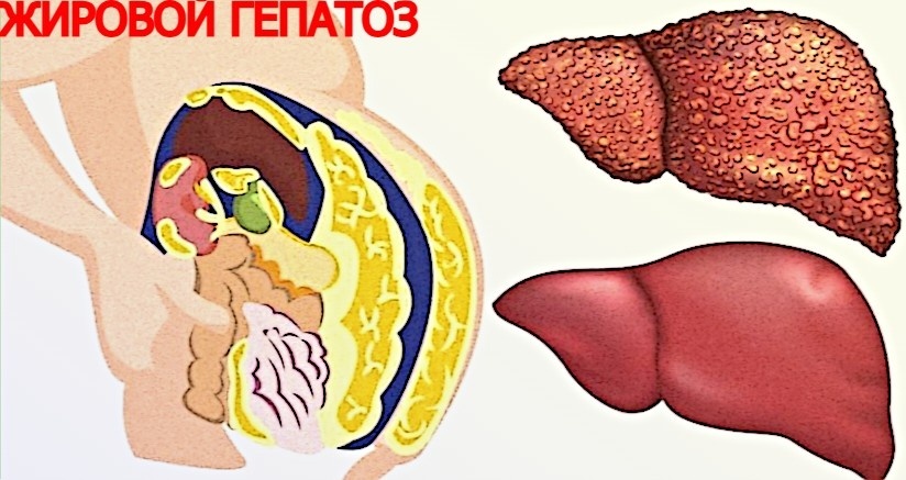 Печень в жире: тихая тревога, которую нельзя игнорировать