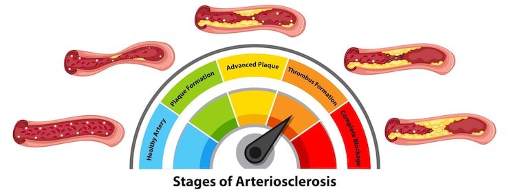 11 простых способов быстро снизить уровень холестерина