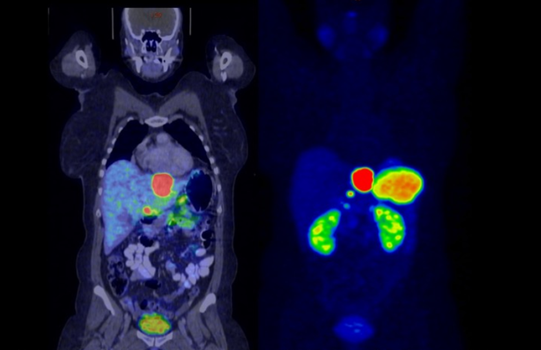 ПЭТ-КТ с Галлием-68 DOTATATE
