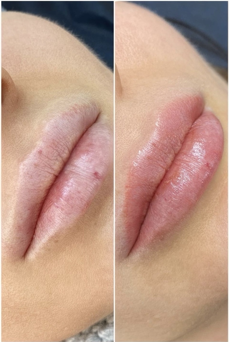 До/зажившие