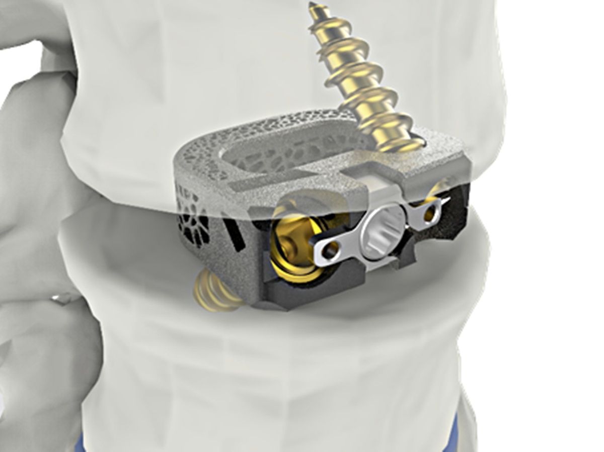 Поясничный имплантат «Unispace» компании CG MedTech, получивший разрешение на продажу от FDA США.