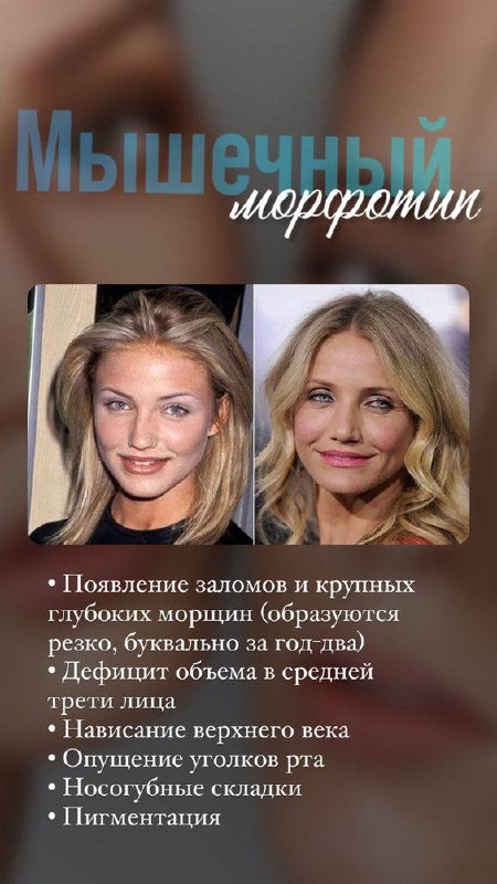 Мышечный морфотип