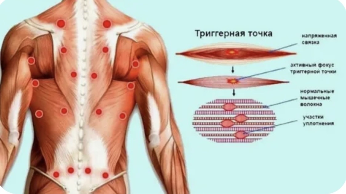 Как выглядят триггерные точки
