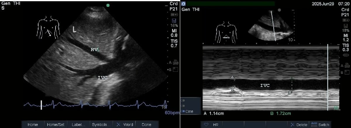 Рис. 1. Датчик в проекции эпигастрия. Демонстрируется печень (L) с нижней полой веной (IVC) и левой печеночной веной (HV)