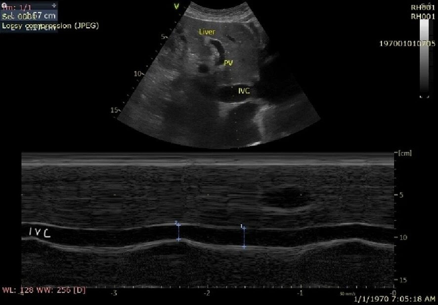 Рис. 2. Датчик в проекции эпигастрия. Демонстрируется нижняя полая вена (IVC) и ее респираторная вариабельность, а также воротная вена (PV)
