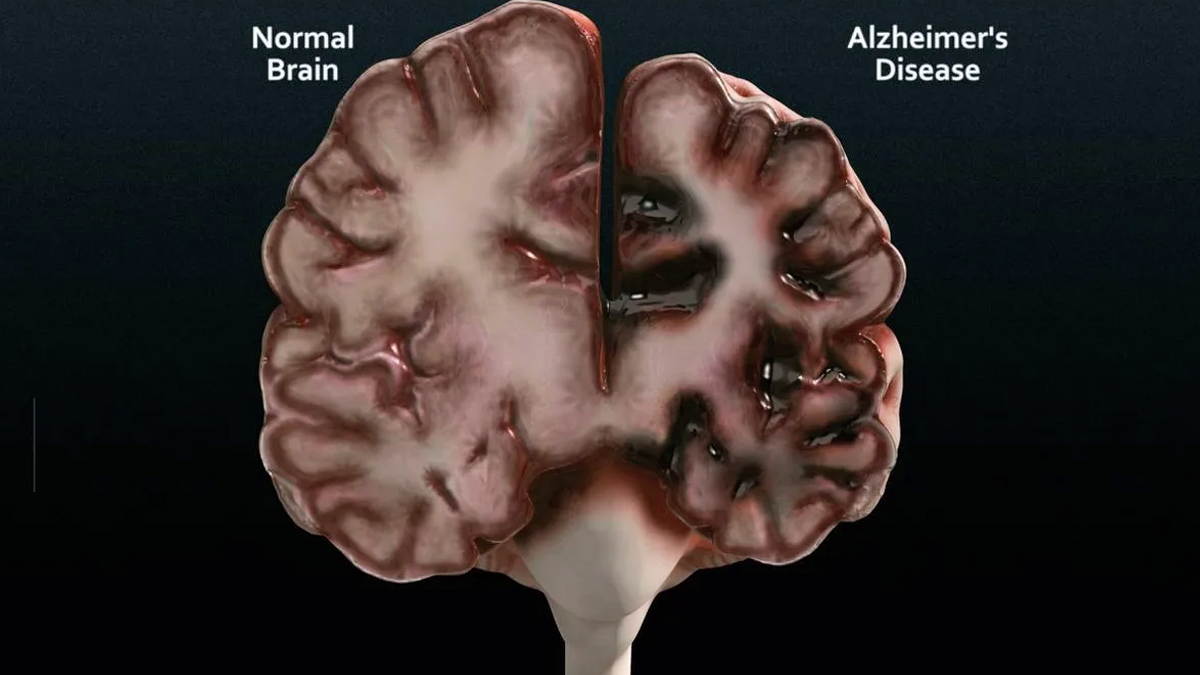 Разница между нормальным мозгом и мозгом у коротого была диагностирована болезнь Альцгеймера