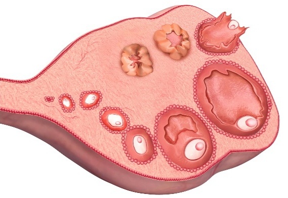 Источник:Pankhurst MW. The elusive function of AMH signaling in folliculogenesis. J Assist Reprod Genet. 2025 Oct;42(10):3257-3258. doi: 10.1007/s10815-025-03657-5. Epub 2025 Sep 19. PMID: 40971085; PMCID: PMC12602740.