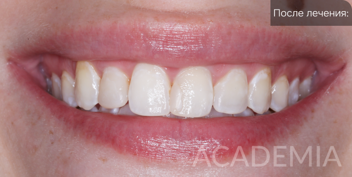 Лечение тяжелой степени флюороза в нашей клинике ACADEMIA